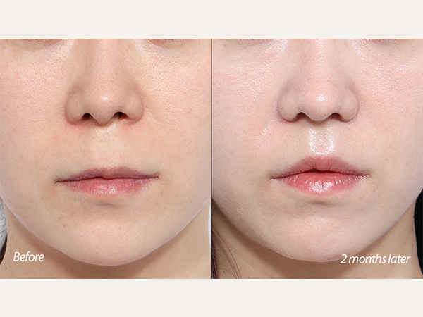 lip lift and revision tip plasty