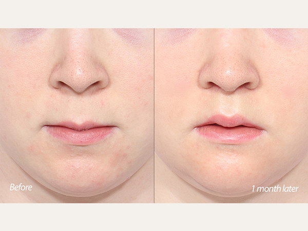 lip lift 1 month