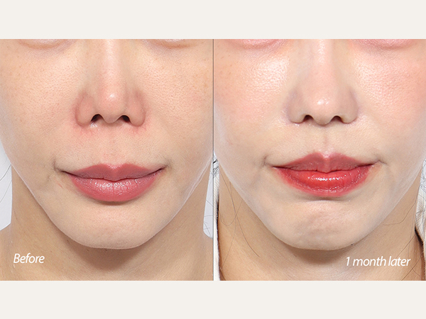 인중축소 + 코끝재수술 1개월차