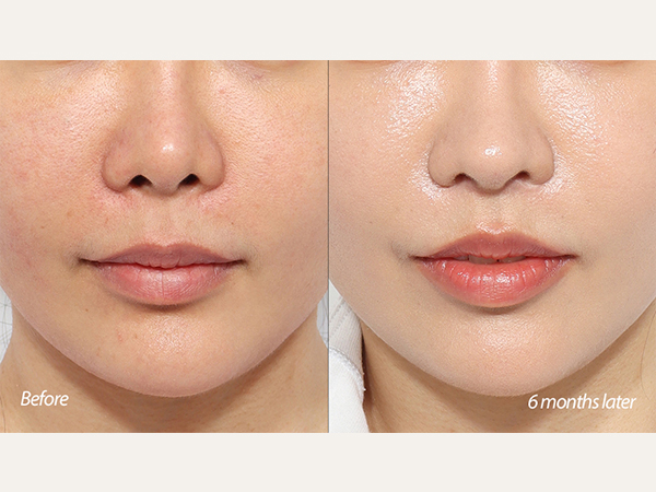 lip lift and revision tip plasty