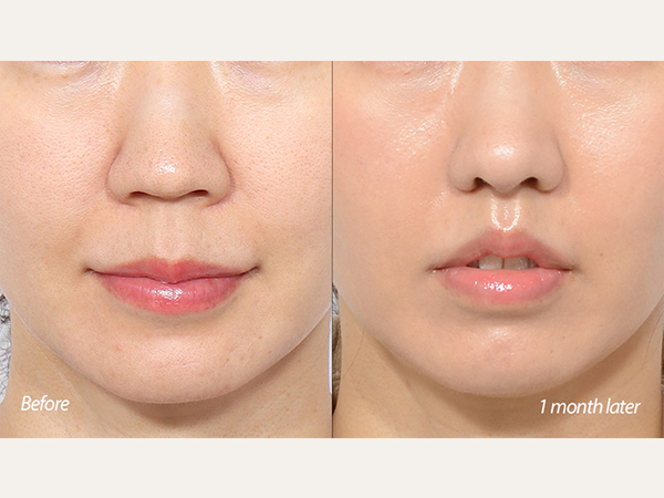 lip lift and rhinoplasty