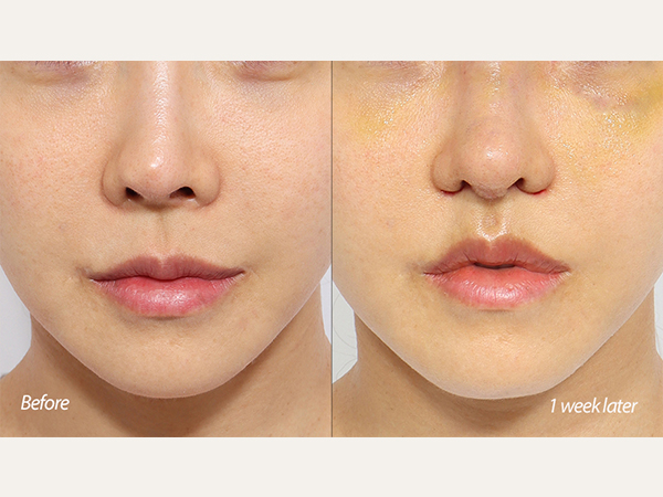 lip lift and revision rhinoplasty