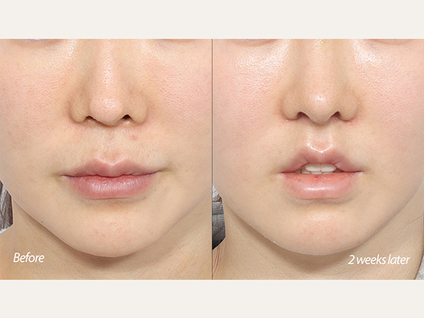 lip lift and revision tip plasty