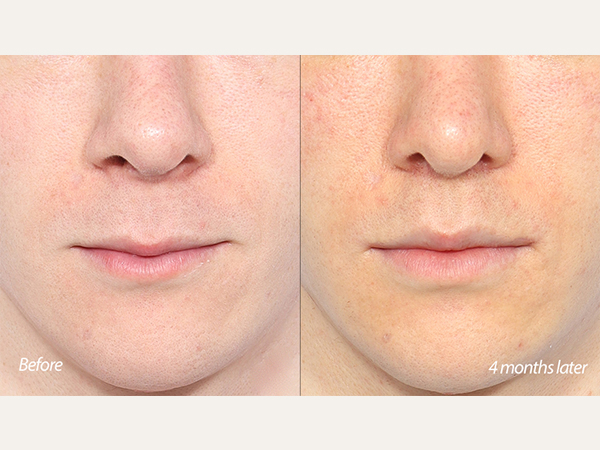 lip lift and revision tip plasty