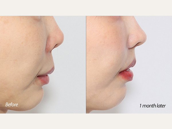 lip lift and revision tip plasty