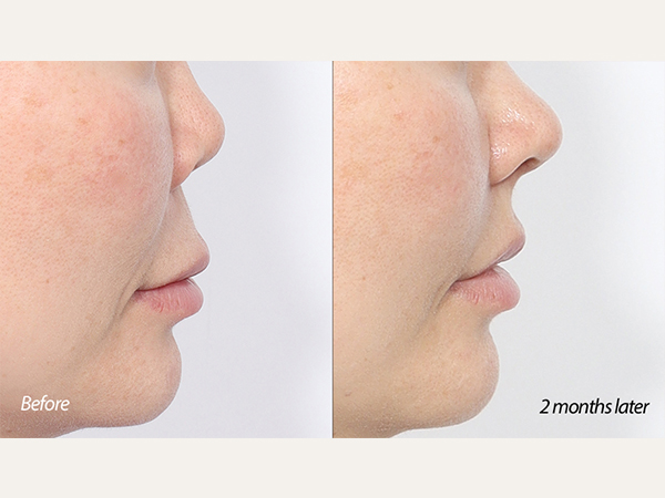 lip lift and revision rhinoplasty