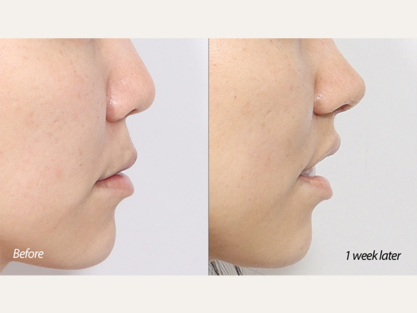 lip lift and tip plasty