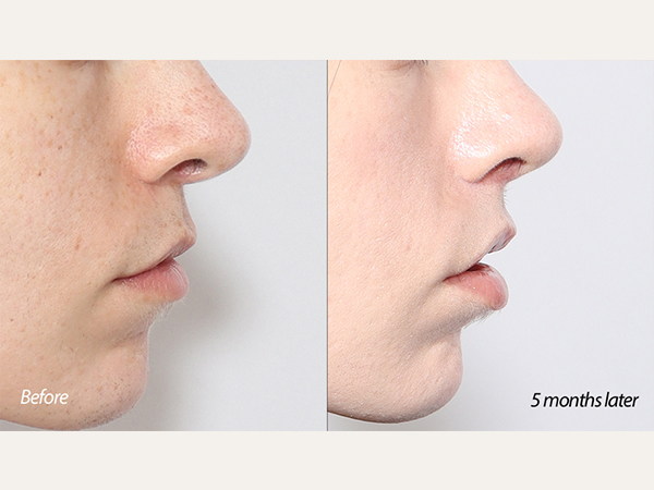 lip lift and revision tip plasty