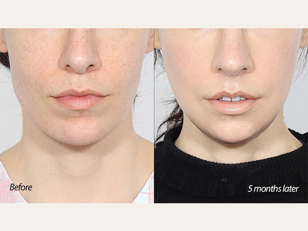 square jaw surgery (mandibular angle reduction)