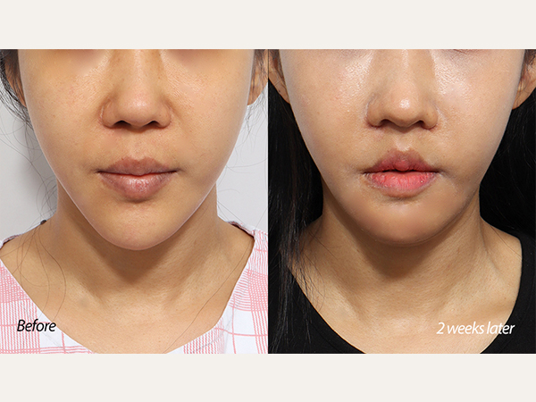 revision chin reduction (revision genioplasty)