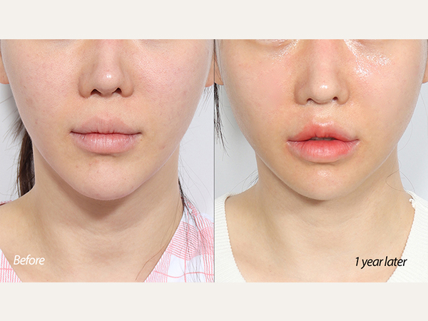 revision chin reduction (revision genioplasty)