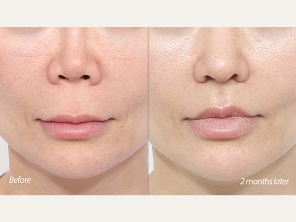 인중축소 + 코재수술 2개월차