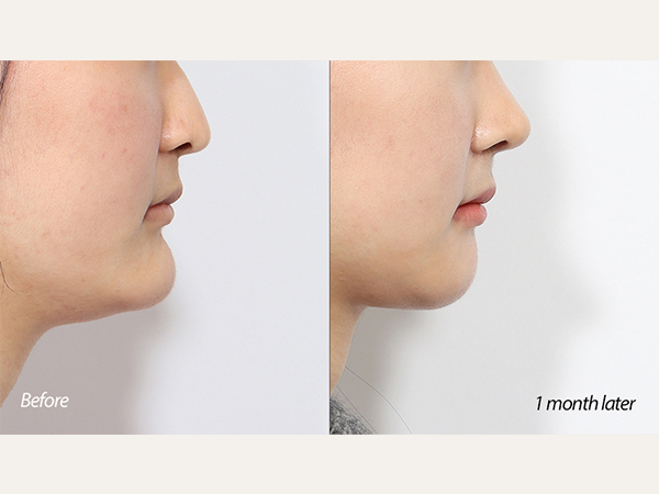 미니브이라인 1개월차