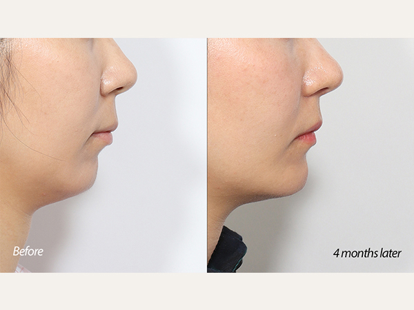 genioplasty and chin advancement
