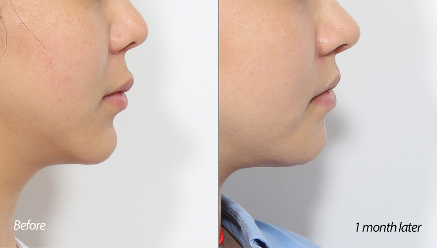 턱끝재수술 1개월차