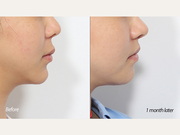 revision chin reduction (revision genioplasty)