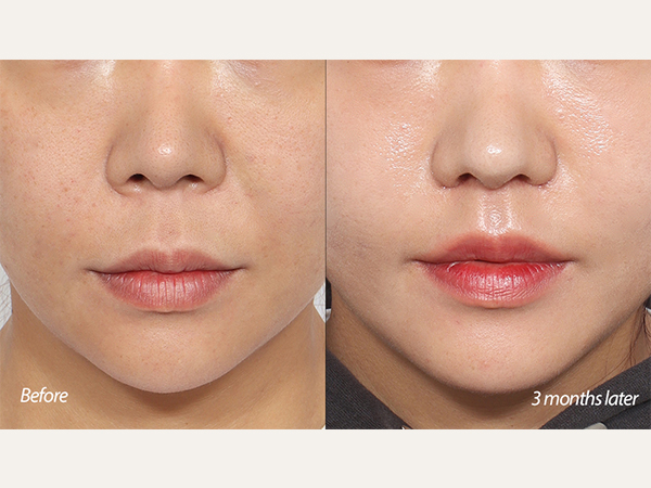 인중축소 및 코끝재수술 lip lift and tip revision