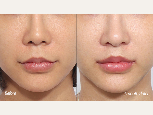 Lifting de comisuras labiales, revisión de lifting de labios y revisión de rinoplastia.