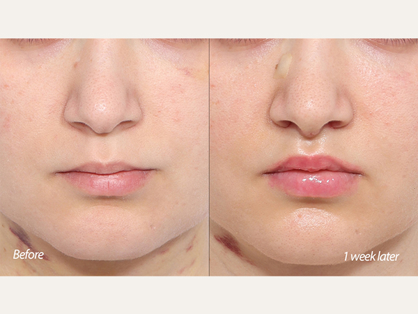 인중축소 lip lift upper lip lift