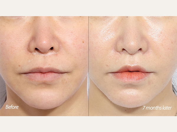 Cirugía de revisión de reducción de filtrum, lifting de labios con reducción de filtrum, lifting de labios de revisión con reducción de filtrum