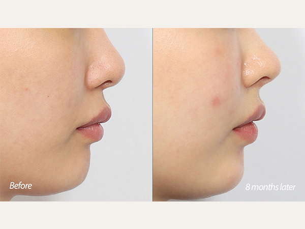 Rinoplastia de reducción de filtrum, rinoplastia de revisión, lifting de labios