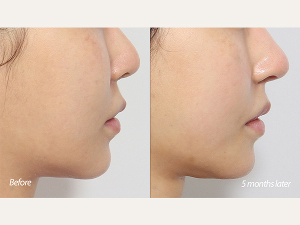 lip lift, revisional tip plasty andgenioplasty