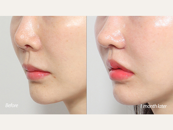 Lip lift and revisional tip plasty