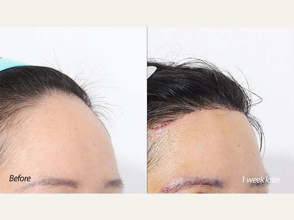이마축소 forehead reduction 인중축소 lip lift