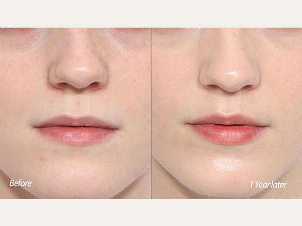 인중축소 scarless lip lift, lip lift, philtrum reduction, upper lip lifting