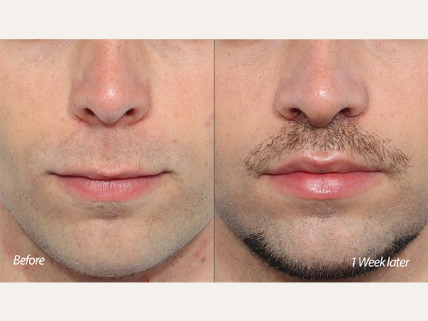 lip lift, upper lip lifting, scarless lip lift, philtrum reduction, male lip lift, french