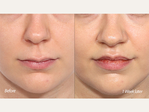 Scarless lip lift, philtrum reduction, upper lip lifting, lip lift, before and after picture of lip lift