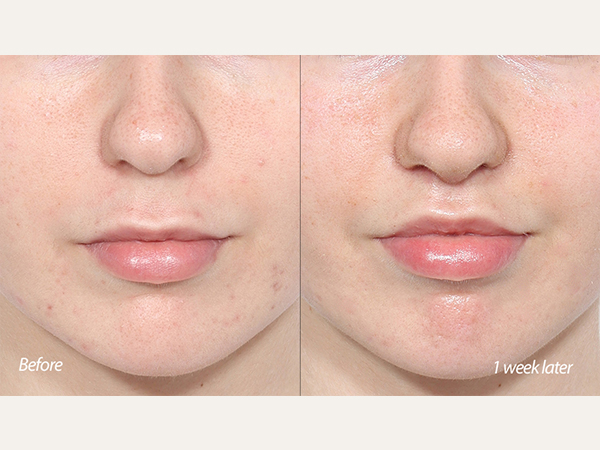 Scarless lip lift, philtrum reduction, and upper lip lifting