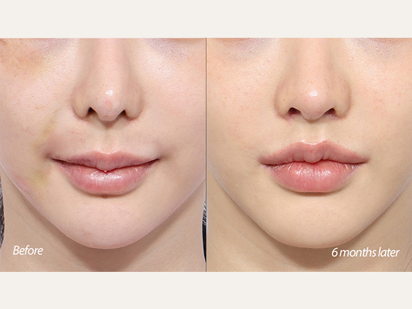 mouth corner lift, scarless lip lift, and nose revision
