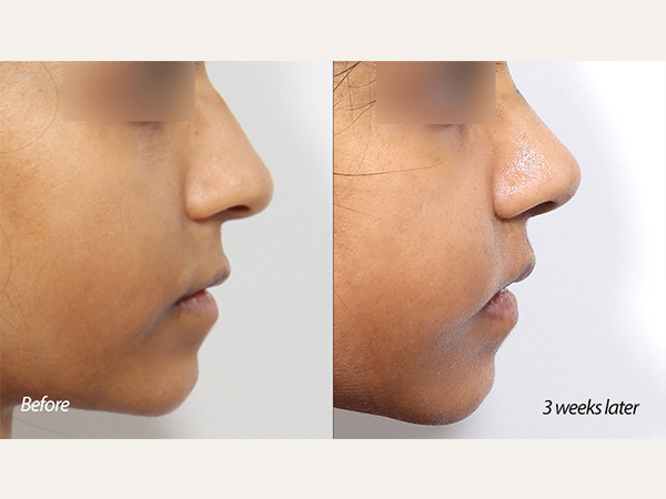 rhinoplasty, nose job, humped nose, scarless lip lift, indian