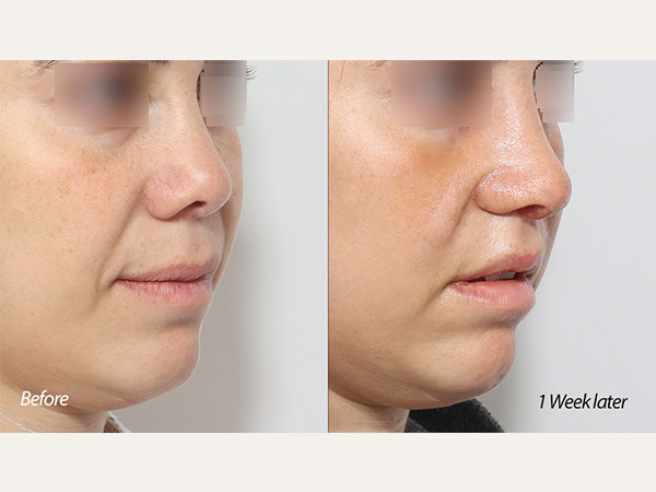 scarless lip lift 인중축소, tip plasty 코끝 재수술, middle east nose 중동 코수술