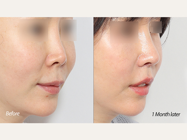 Scarless lip lift, lip lift, philtrum reduction, upper lip lifting, revisional rhinoplasty, and nose revision