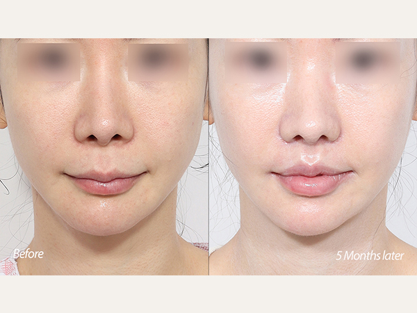 scarless lip lift, lip lift, upper lip lifting, philtrum reduction, endonasal lip lift, revisional rhinoplasty, multiple rhinoplasty, nose revision