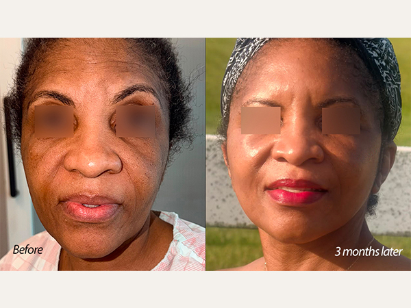 안면거상 미니거상 딥플레인 facelfit minilift deep plane