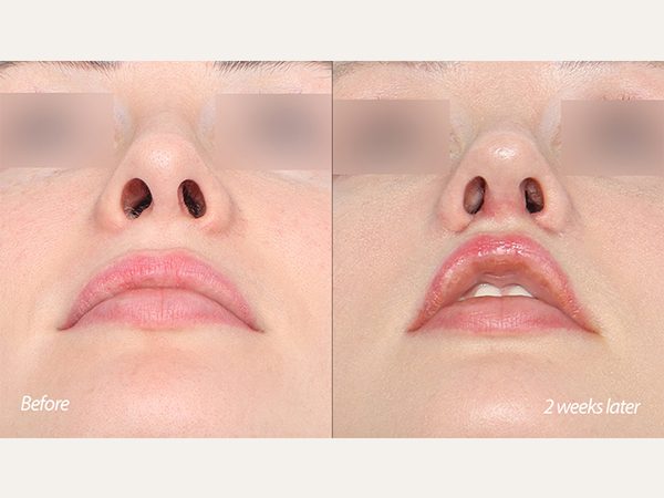 scarless lip lift 인중축소, 비주 교정 columella, tip revision 코끝재수술